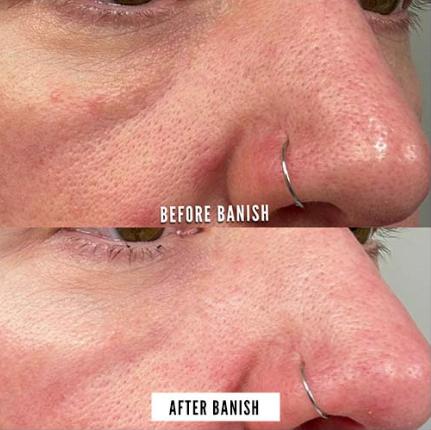Tiktok Shop Only - Collagen Essentials Set -  Spa Results at Home.  Banish Kit with 2 replaceable heads, Vitamin C, E, Ferulic Serum and Fighter Gel