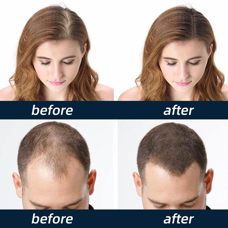 5% Minoxidil Hair Growth Spray, For Hair Thinning And Hair Growth, Hair Growth Treatment For Thicker And Fuller Hair